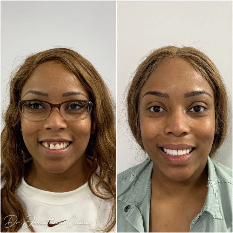 See how this patient’s smile was transformed with precision cosmetic dentistry. A confident, complete smile with expert veneer work – Beverly Hills Dentistry.