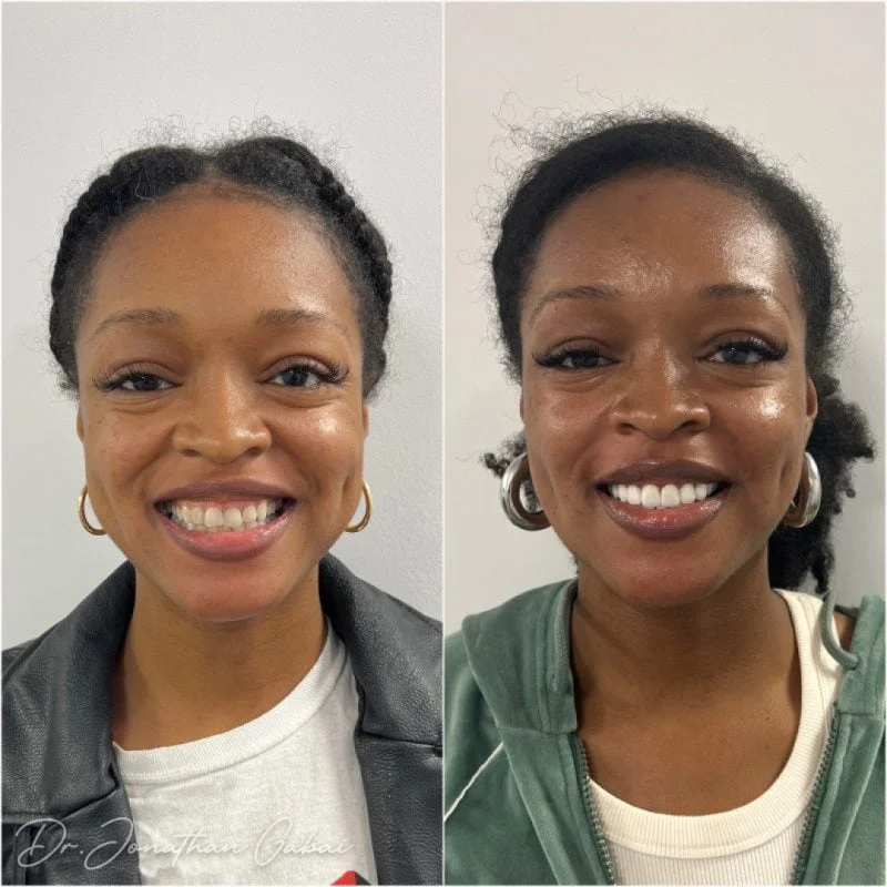 Witness the radiant smile transformation of a happy patient. Dr. Gabai’s expert cosmetic dentistry restores confidence with natural, beautiful results – Beverly Hills Dentistry.