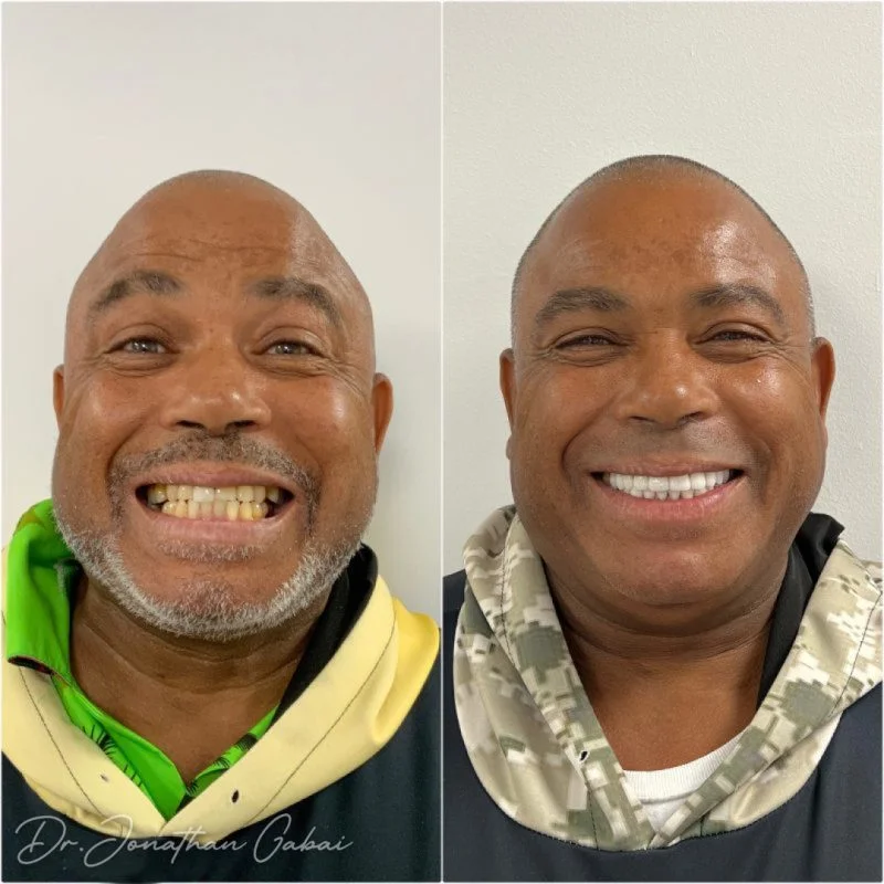 A powerful before-and-after showing the artistry of Dr. Gabai's smile restoration. See the life-changing impact of expert cosmetic dentistry – Beverly Hills Dentistry.
