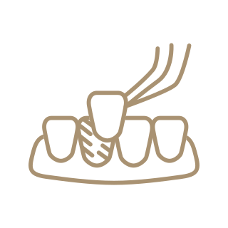 Dental Veneers in Beverly Hills, CA