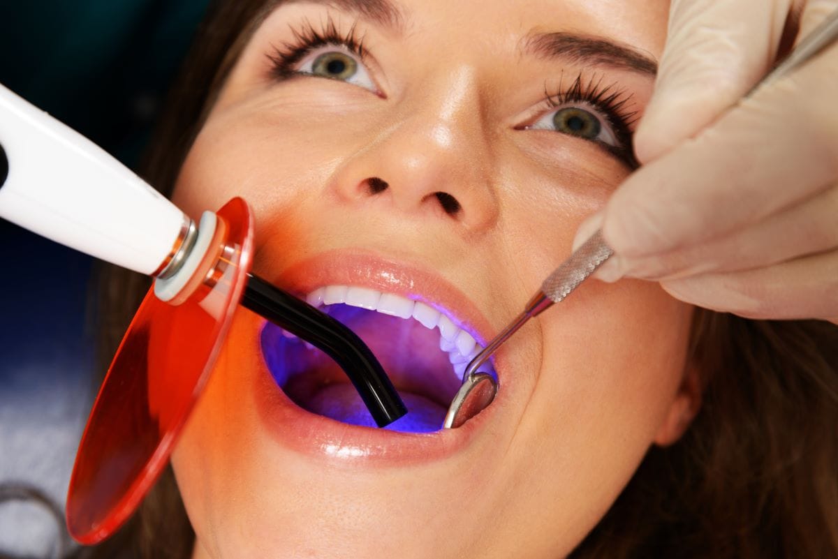 Dentist performing a tooth filling procedure using a curing light inside a patient's mouth during a dental restoration treatment