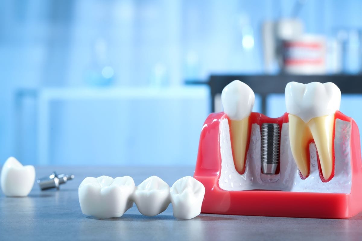 Dental model showing a dental bridge and implant components on a table, illustrating tooth restoration options in a clinical setting.