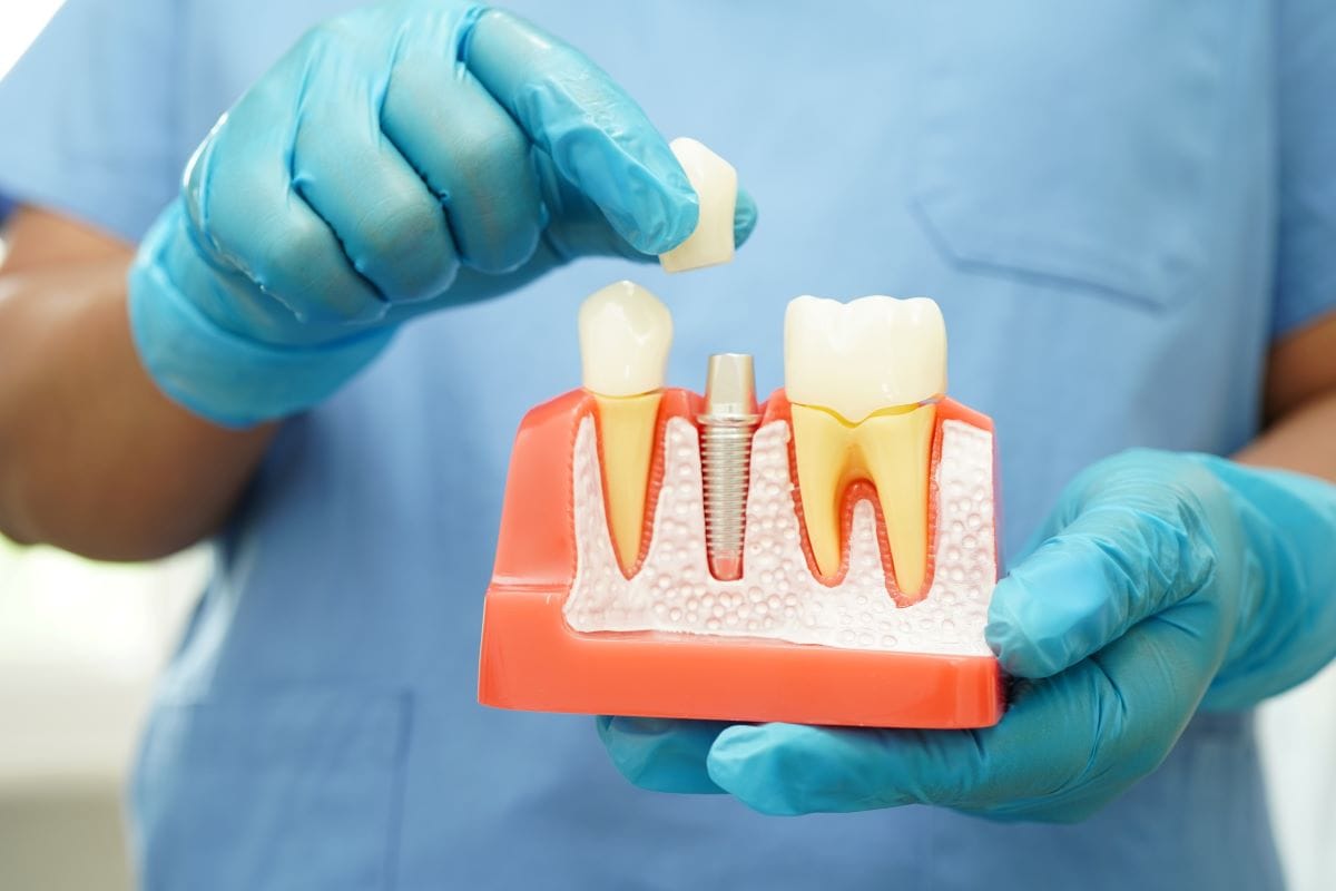 Gloved hands holding a dental model showing a dental implant being fitted with a dental crown next to natural teeth.