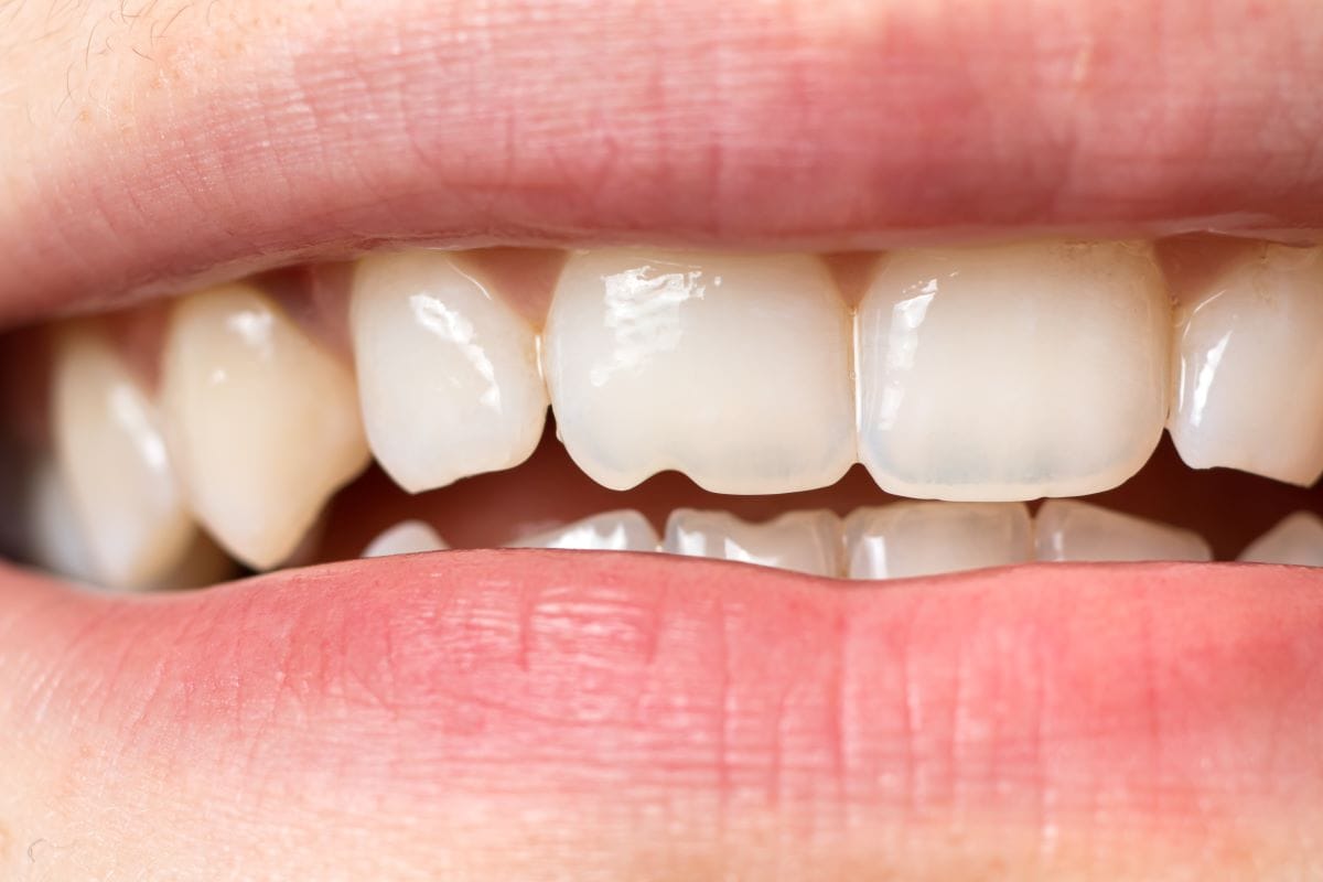 Close-up of a person's smile showing a visible chipped tooth on the upper front row, highlighting dental damage.