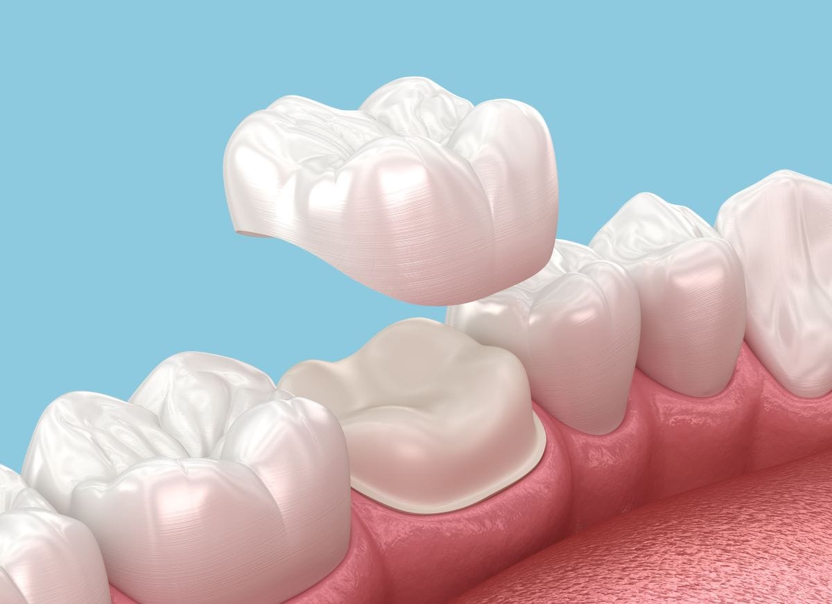 3D illustration of a dental crown being placed over a prepared tooth, showing how a dental crown fits and restores tooth structure.