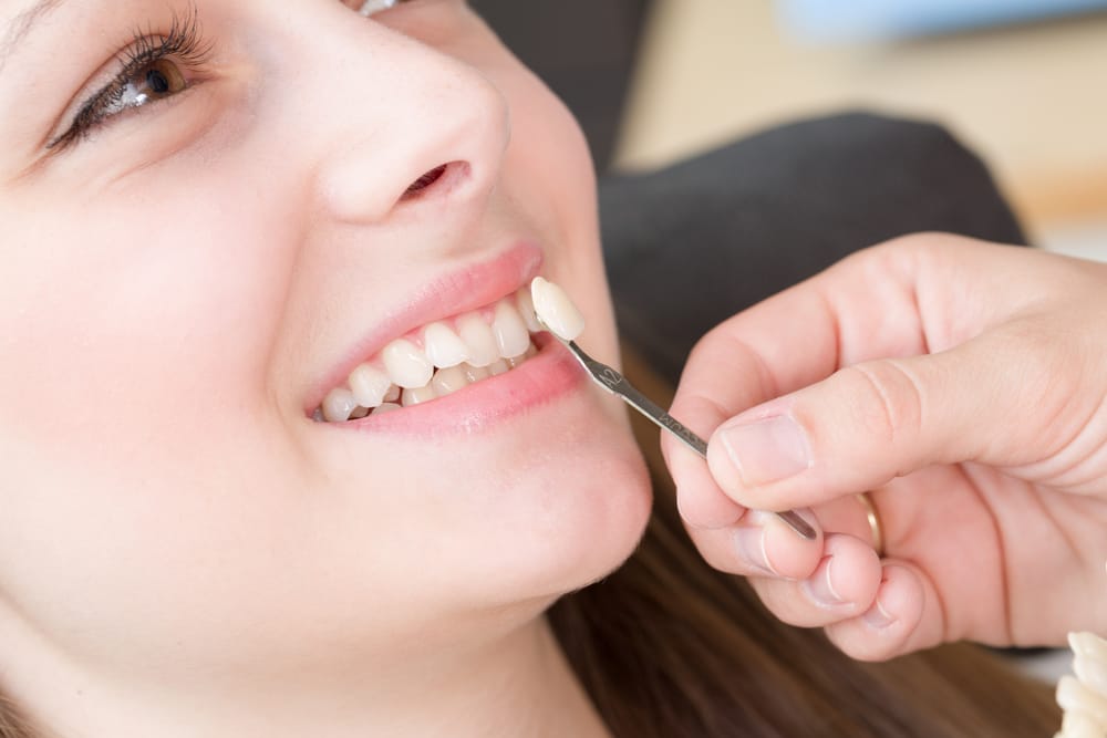Close-Up of Porcelain Veneer Color Matching  Close-up of a woman’s smile while a dentist holds a veneer against her teeth to match the perfect shade